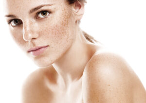 freckles woman face portrait | Matsimela Home Spa